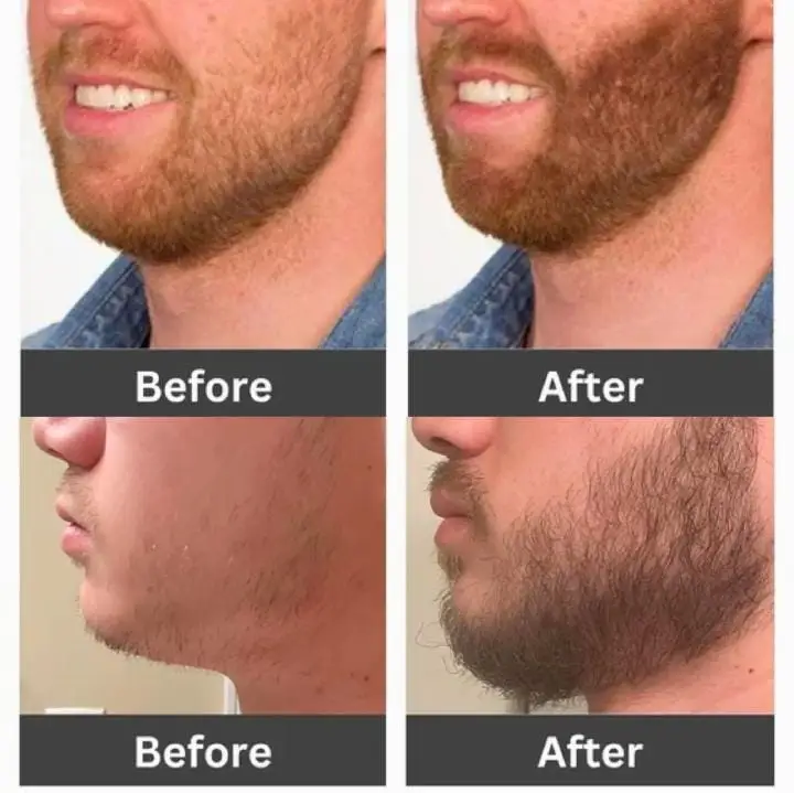 Hair Max Spray 60ml โ Minoxidil 5% Hair Regrowth & Hair Loss Treatment - Image 3