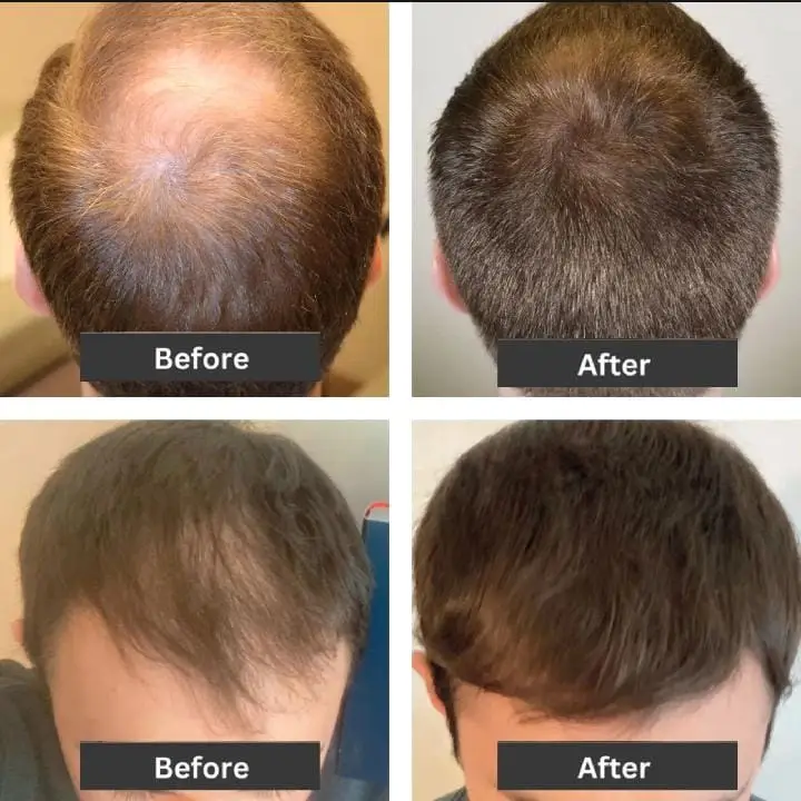 Hair Max Spray 60ml โ Minoxidil 5% Hair Regrowth & Hair Loss Treatment - Image 2
