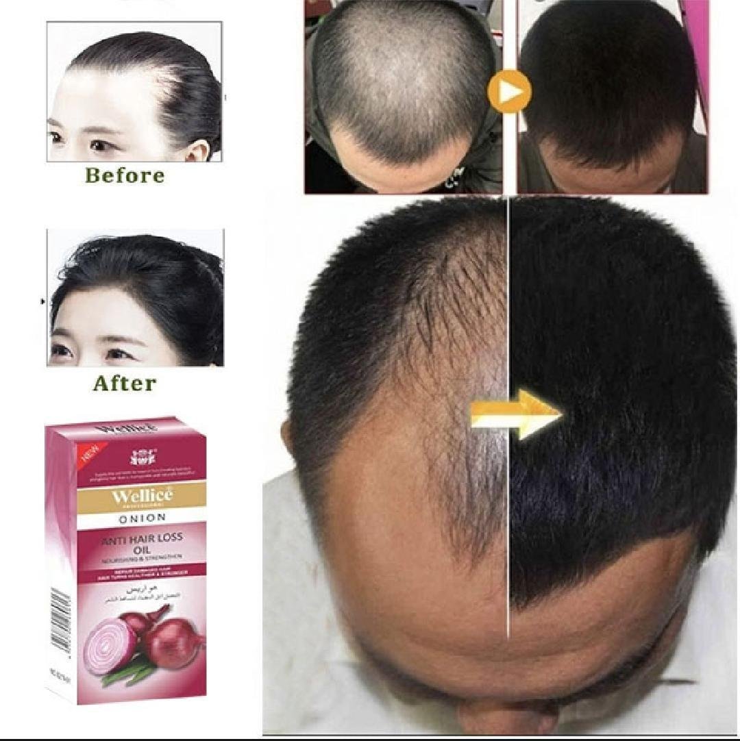Wellice Onion Anti-Hair Loss Hair Oil 100ml โ Onion Hair Growth & Scalp Care Oil - Image 3