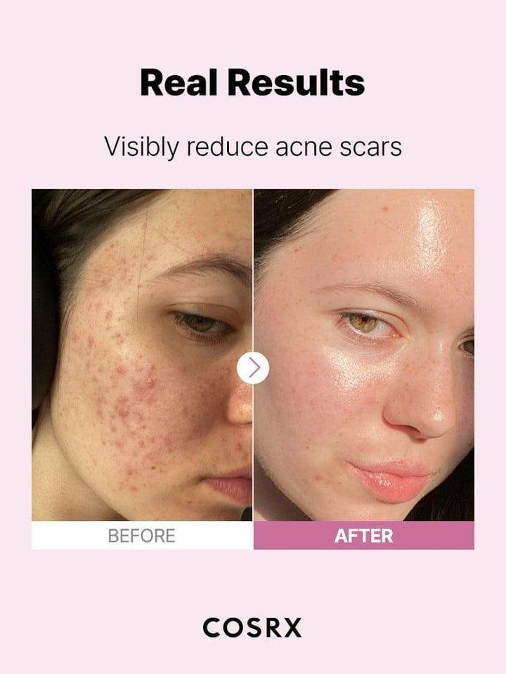 Niacinamide Serum 20ml Anti-Acne & Even Tone – Brightening Face Serum for Blemishes, Oil Control & Radiant-Looking Skin - Image 5